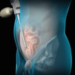 inguinal hernia surgery