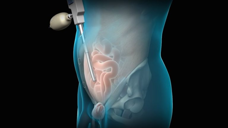 inguinal hernia surgery